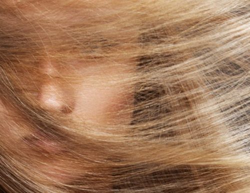 Lozioni anticaduta: quali utilizzare per arrestare la caduta dei capelli